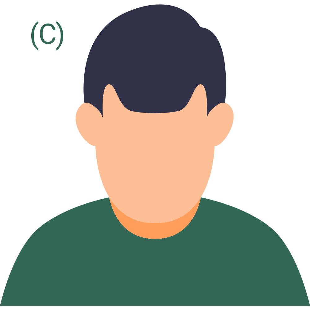 Hair Loss Pattern 3