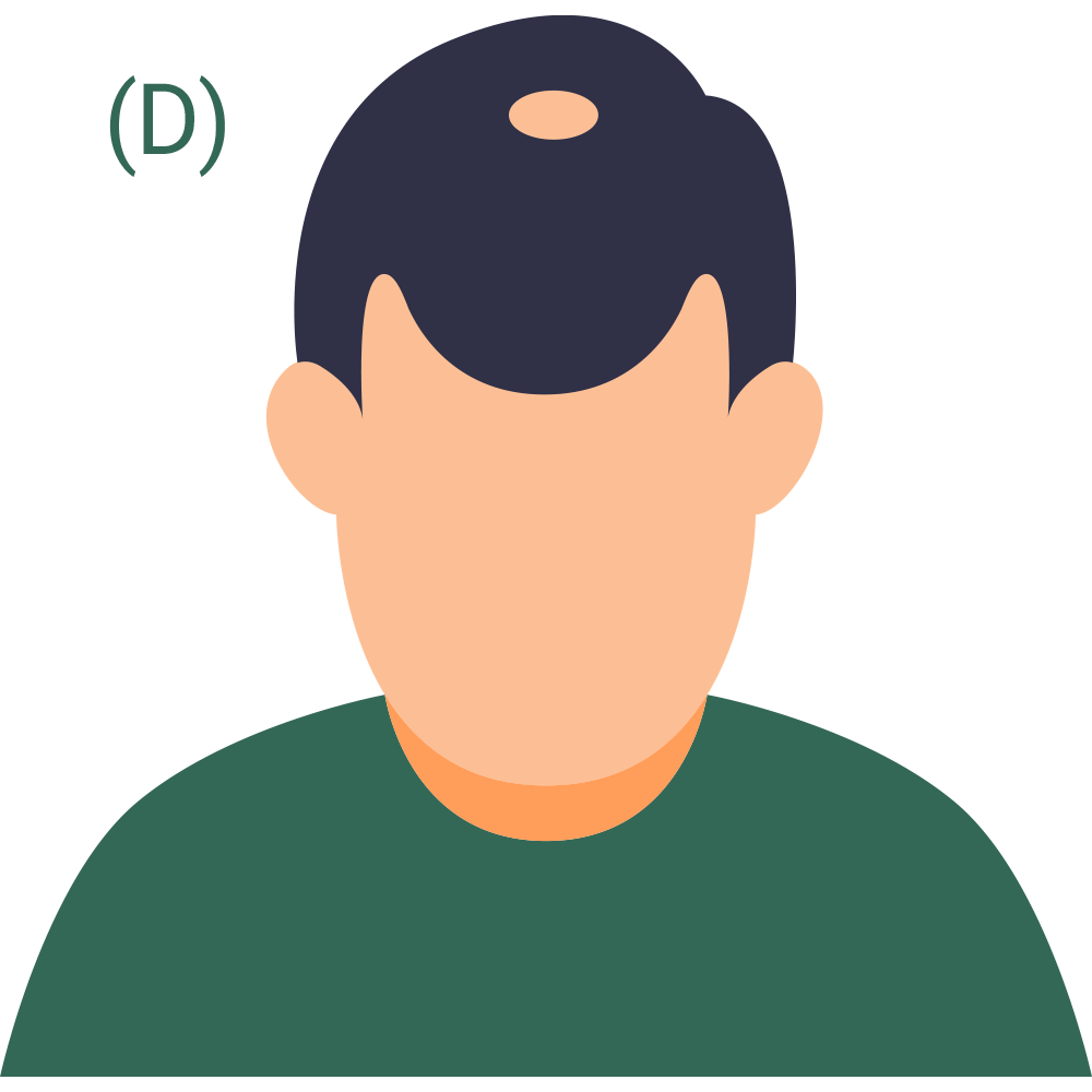 Hair Loss Pattern 4