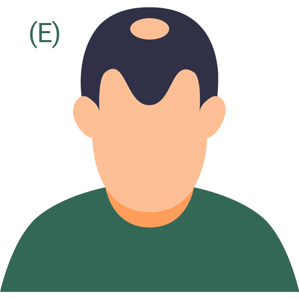 Hair Loss Pattern 5