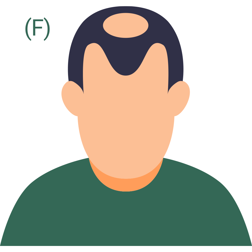 Hair Loss Pattern 6