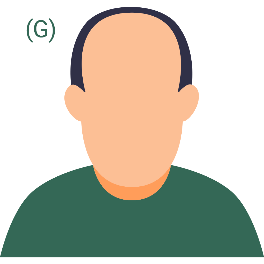 Hair Loss Pattern 7