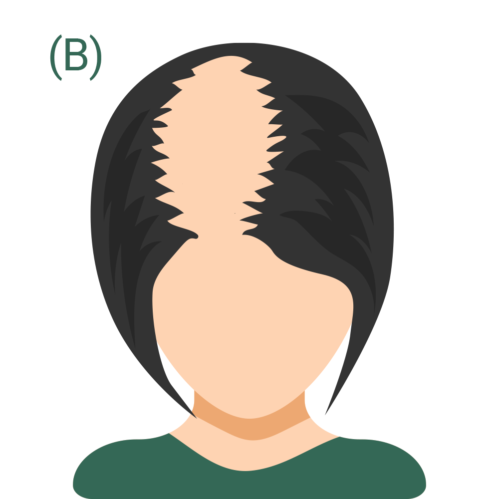 Hair Loss Pattern 2