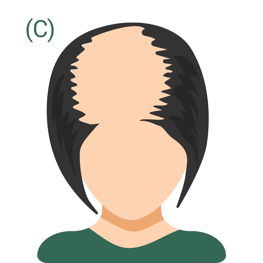 Hair Loss Pattern 3